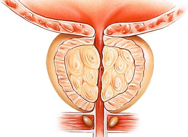 illustration of the inflamed prostate
